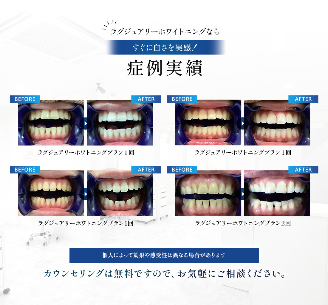 YCホワイトニング公式掲載のラグジュアリーホワイトニング症例。施術前後の歯の色を4例で示した画像